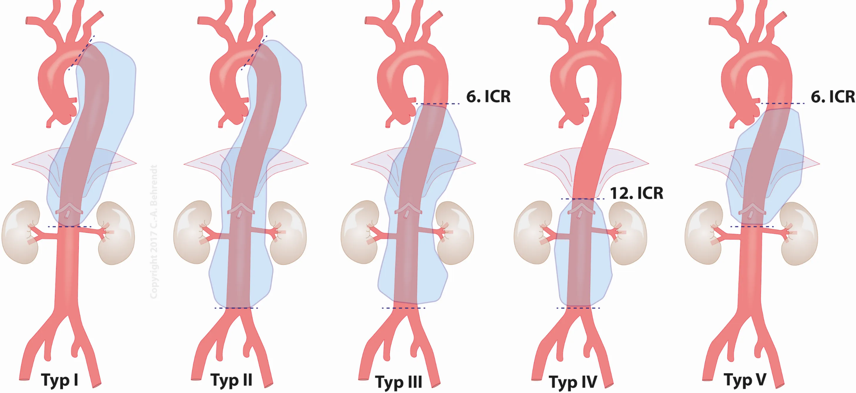 Gesundheitsinfos Aneurysma