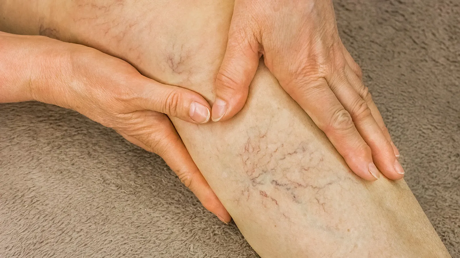 Gesundheitsinfos Krampfadern