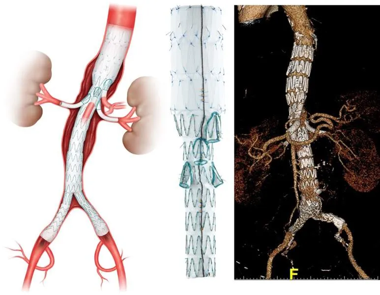 Leistungen bei einem Aneurysma